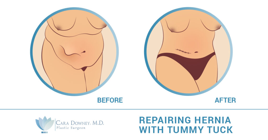 Muscle Repair During Tummy Tuck - Dr. Hess
